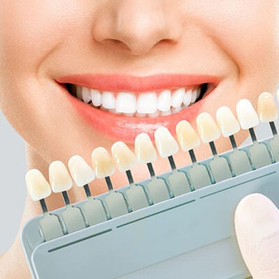 Blanchiment des dents pour esthétique dentaire à Namur
